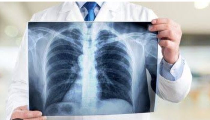 Diduga Rontgen di RSUD Sanana Tak Layak, Foto Rontgen Pasien Dibatasi